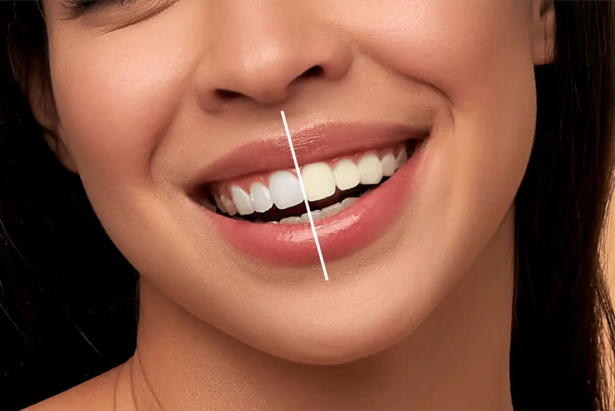 بلیچینگ دندان چیست؟ آیا برای همه مناسب است؟ + مزایا و معایب