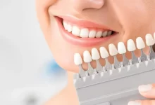 نحوه اجرای لمینت دندان