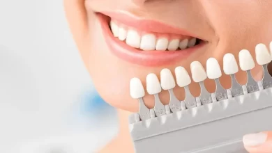 نحوه اجرای لمینت دندان