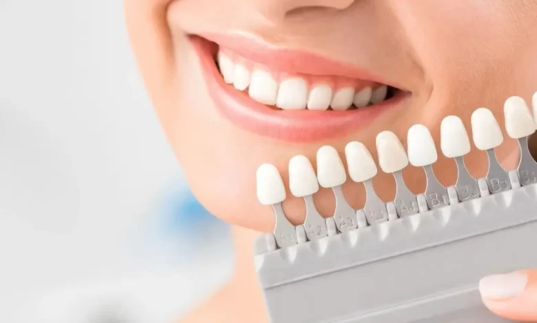 نحوه اجرای لمینت دندان