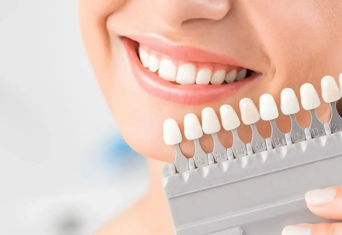 لمینت دندان چیست؟ چه نکاتی را باید قبل از شروع بدانید؟ +نحوه اجرا