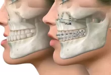آشنایی کامل با روند جراحی فک؛ از هزینه و تغییرات چهره تا خطرات