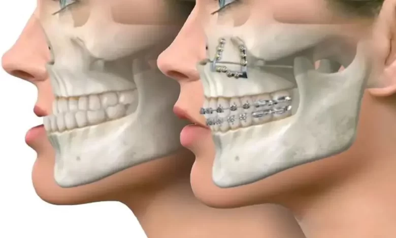 آشنایی کامل با روند جراحی فک؛ از هزینه و تغییرات چهره تا خطرات