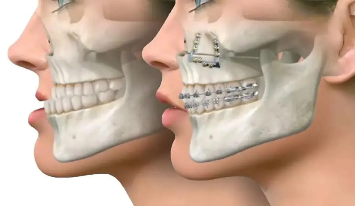 آشنایی کامل با روند جراحی فک؛ از هزینه و تغییرات چهره تا خطرات