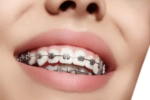 ارتودنسی دندان؛ انواع و شرایط لازم + متخصص ماهر