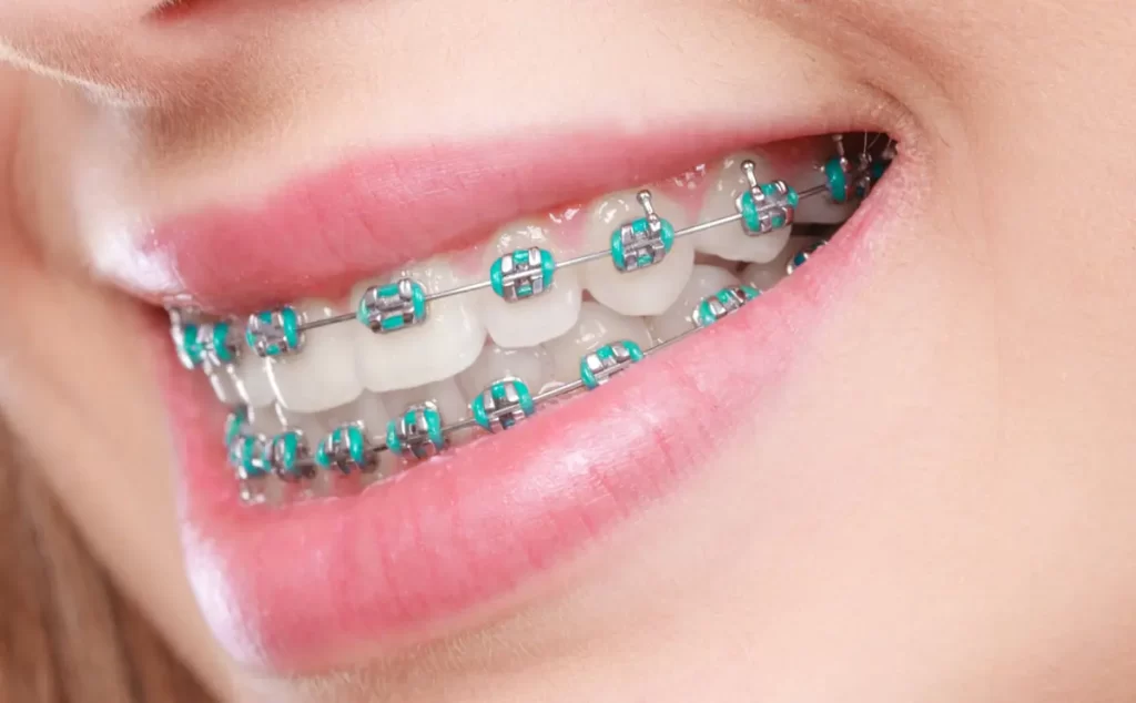 شرایط لازم برای ارتودنسی دنداان