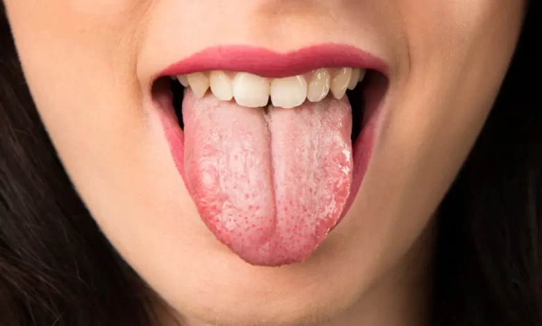 برفک دهان چیست و چگونه درمان می شود؟