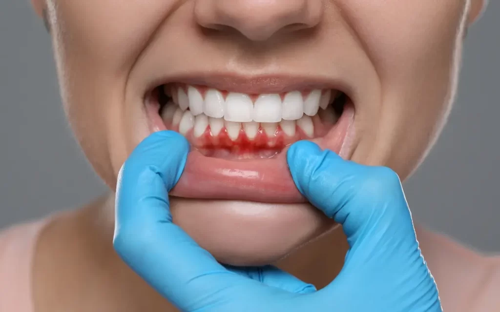 بیماری لثه چیست؟ از نشانه‌های خطرناک تا درمان خانگی