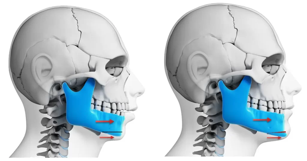 آشنایی کامل با روند جراحی فک
