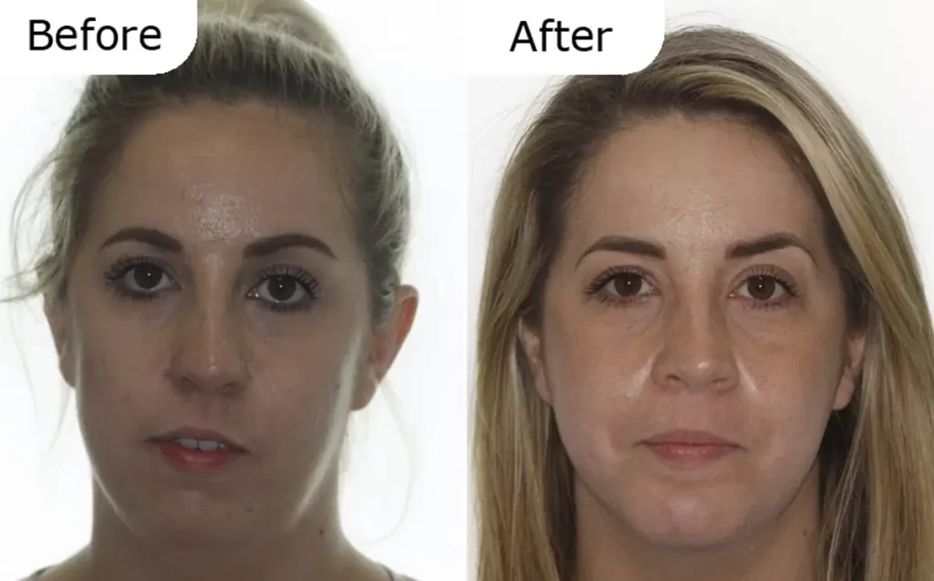 تغییرات چهره بعد از جراحی فک