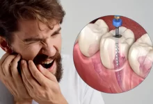 روت کانال دندان چیست و چه فرقی با عصب کشی دارد