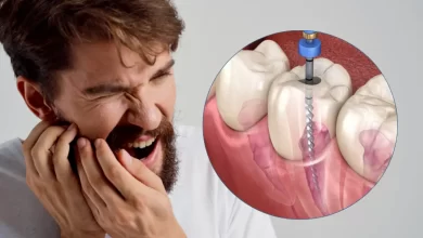 روت کانال دندان چیست و چه فرقی با عصب کشی دارد
