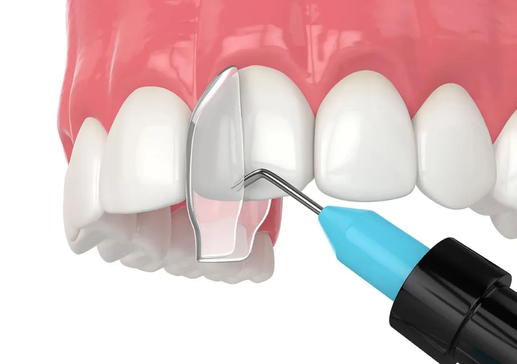 مزایای کامپوزیت دندان