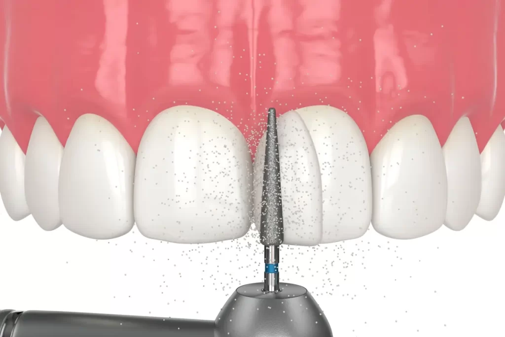 کامپوزیت دندان