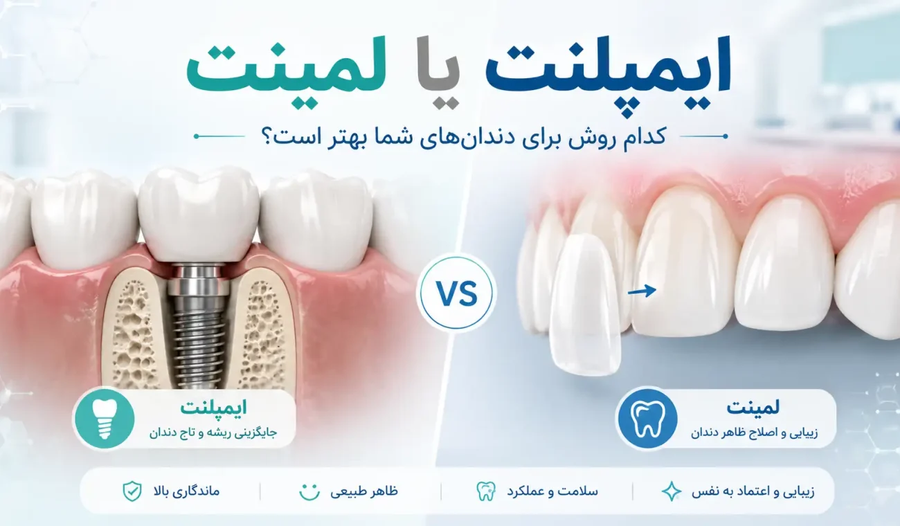 ایمپلنت یا لمینت؛ کدام روش برای دندان‌های شما بهتر است؟