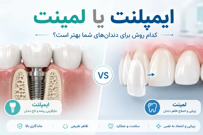 ایمپلنت یا لمینت؛ کدام روش برای دندان‌های شما بهتر است؟