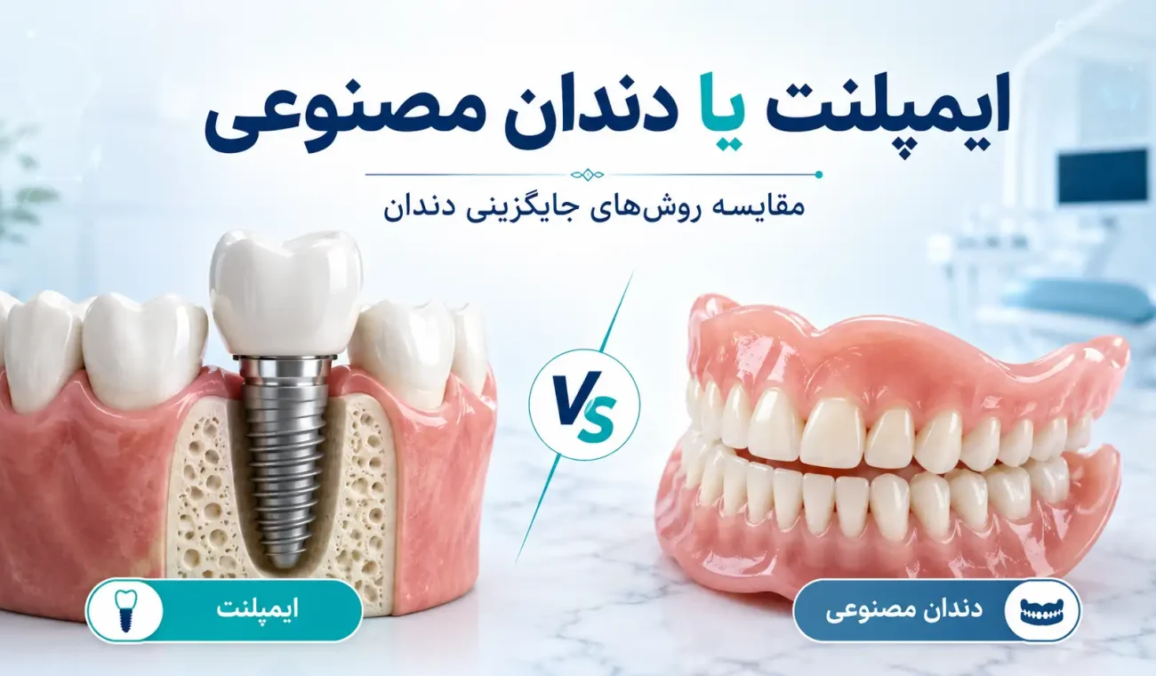 ایمپلنت یا دندان مصنوعی؛ کدام روش برای جایگزینی دندان بهتر است؟