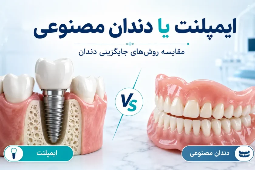 ایمپلنت یا دندان مصنوعی؛ کدام روش برای جایگزینی دندان بهتر است؟