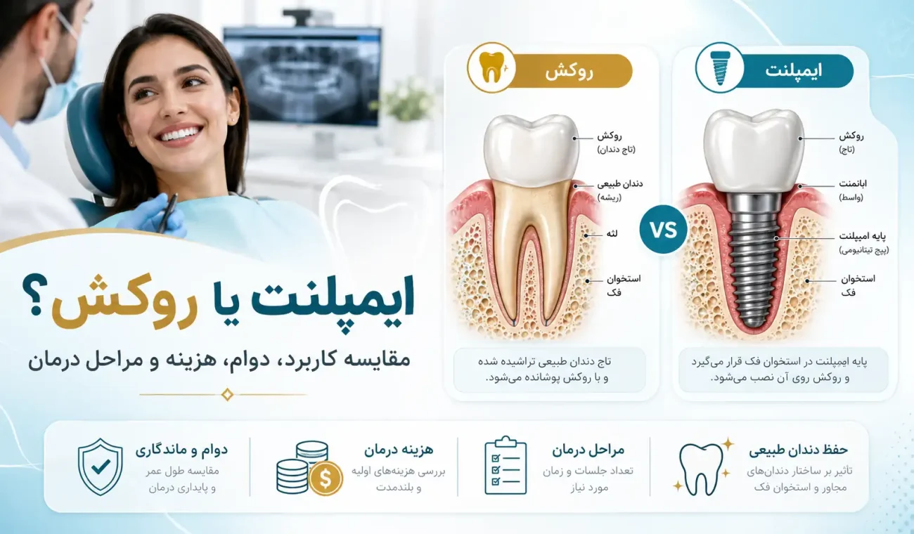 ایمپلنت یا روکش؛ کدام برای دندان شما بهتر است؟