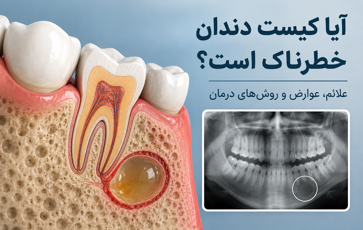 آیا کیست دندان خطرناک است؟ علائم هشدار، عوارض و روش‌های درمان