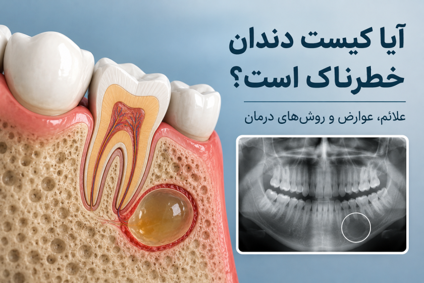 آیا کیست دندان خطرناک است؟ علائم هشدار، عوارض و روش‌های درمان