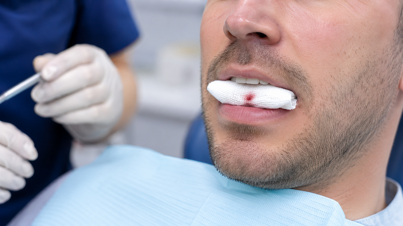 خونریزی لثه 