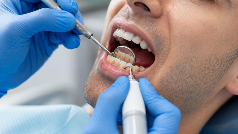 Dental scaling