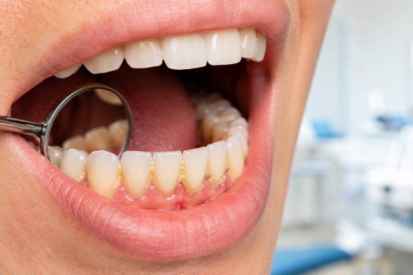 علت تجمع پلاک دندان چیست؟ دلایل تشکیل پلاک و راه‌های جلوگیری از آن