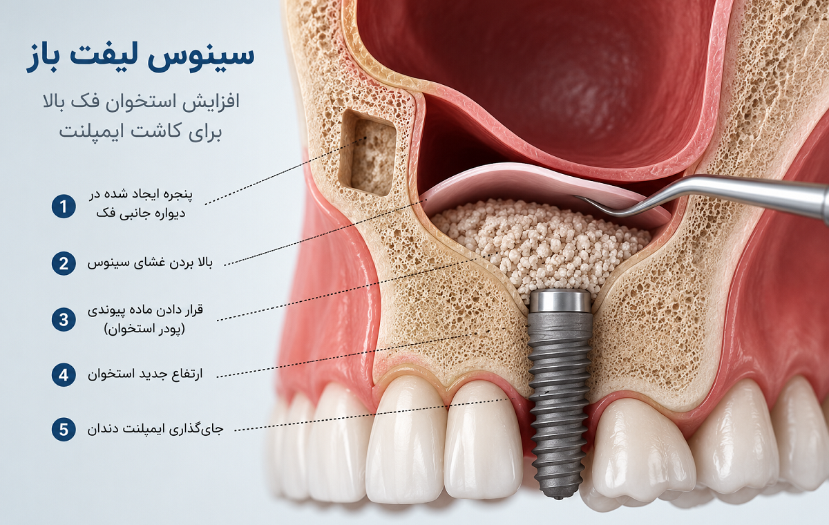 سینوس لیفت باز چیست؟ راهنمای کامل جراحی، مراحل، عوارض و مراقبت‌ها