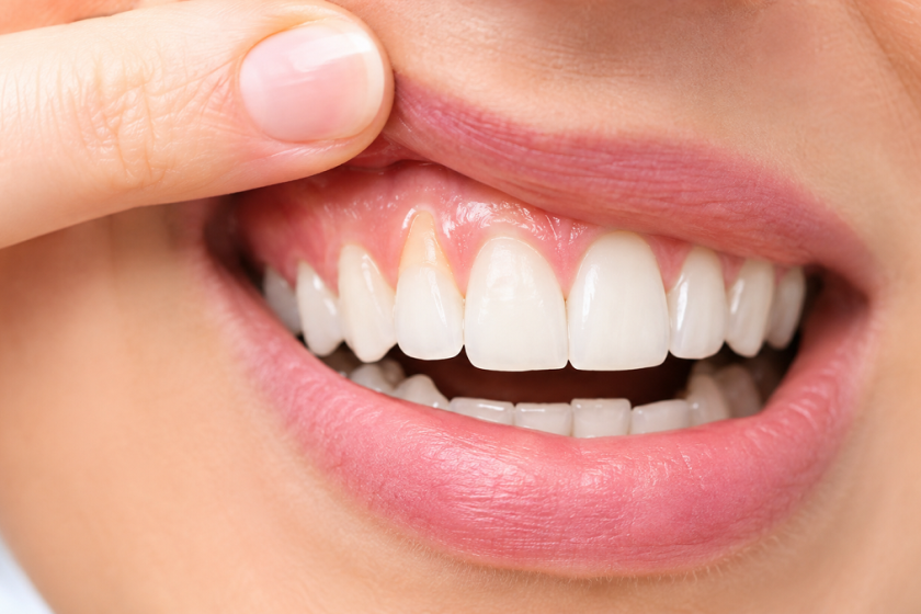 تحلیل لثه چیست؟ علت‌ها، علائم و بهترین روش‌های درمان عقب‌رفتگی لثه