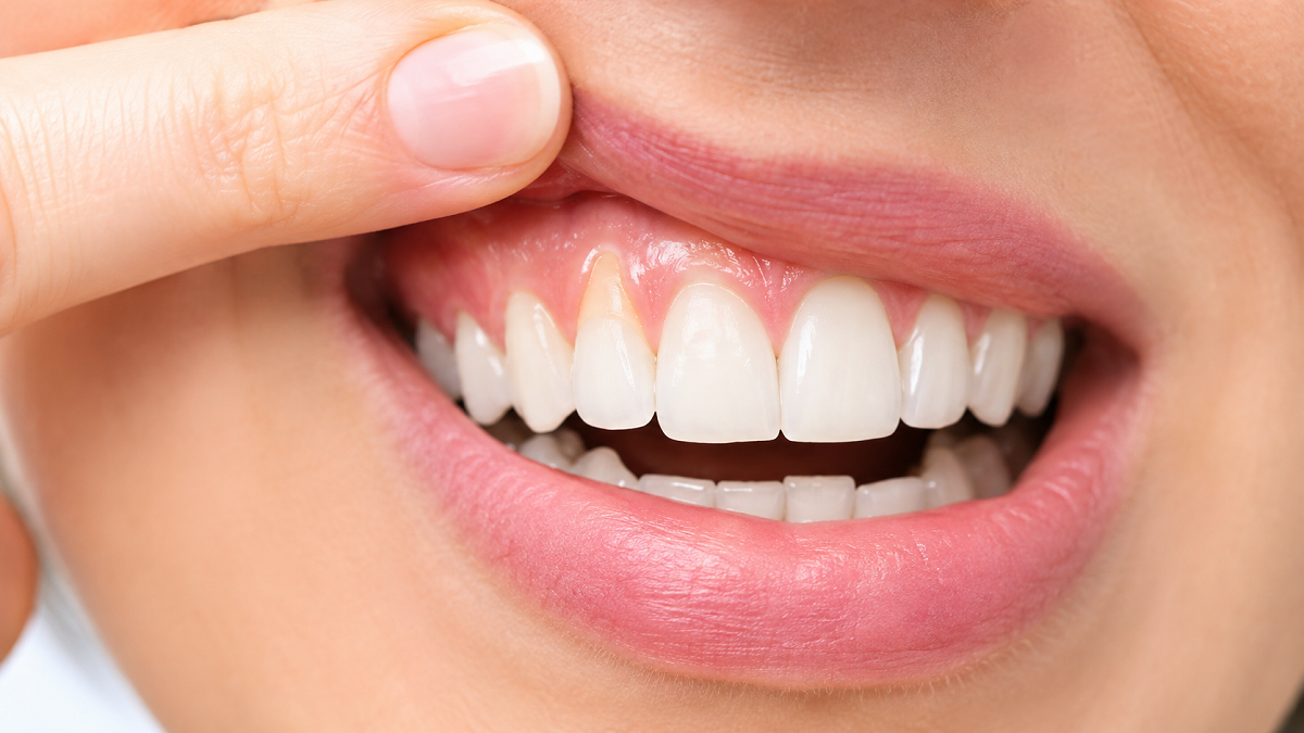 تحلیل لثه چیست؟ علت‌ها، علائم و بهترین روش‌های درمان عقب‌رفتگی لثه