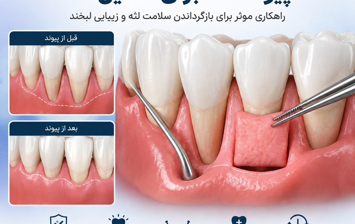 وقتی لثه عقب می‌رود؛ پیوند لثه چگونه تحلیل لثه را درمان می‌کند؟