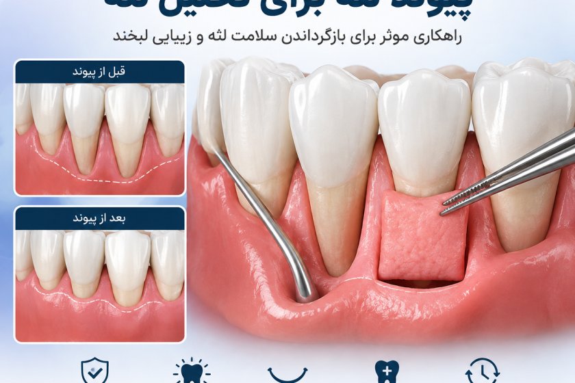 وقتی لثه عقب می‌رود؛ پیوند لثه چگونه تحلیل لثه را درمان می‌کند؟