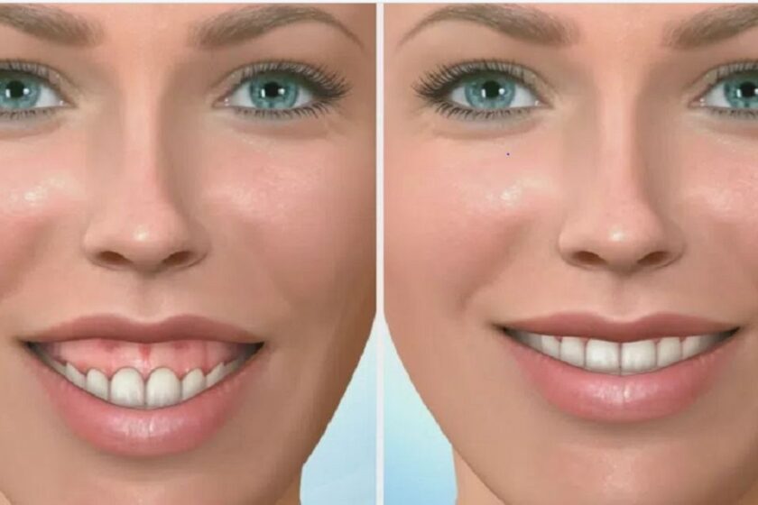 جراحی فک برای لبخند لثه‌ای چگونه انجام می‌شود؟ مراحل، مزایا و مراقبت‌ها