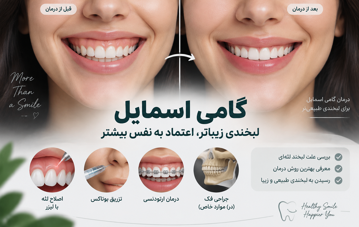 گامی اسمایل چیست و چگونه درمان می‌شود؟ راهنمای کامل اصلاح لبخند لثه‌ای