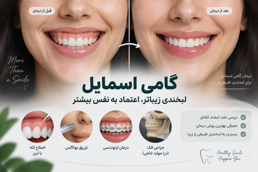 گامی اسمایل چیست و چگونه درمان می‌شود؟ راهنمای کامل اصلاح لبخند لثه‌ای