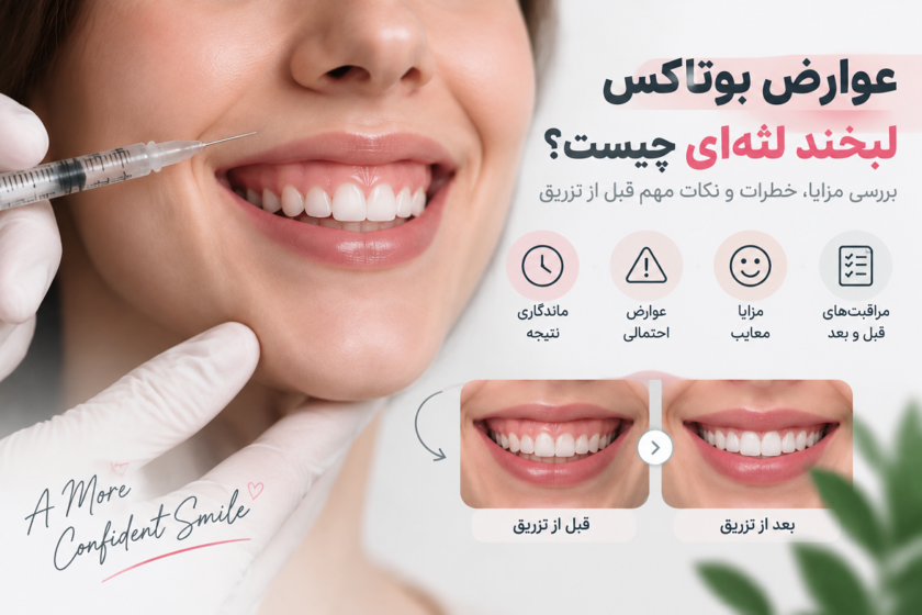 عوارض بوتاکس لبخند لثه‌ای چیست؟ بررسی خطرات، ماندگاری و نکات مهم قبل از تزریق