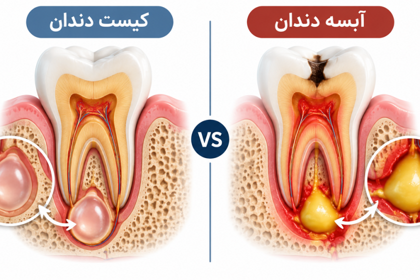 فرق کیست دندان با آبسه چیست؟ راهنمای کامل تشخیص و درمان
