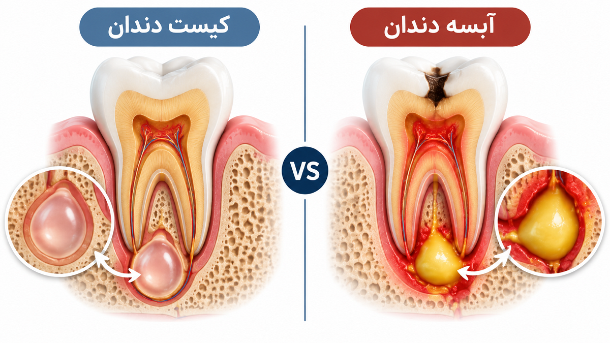 فرق کیست دندان با آبسه چیست؟ راهنمای کامل تشخیص و درمان